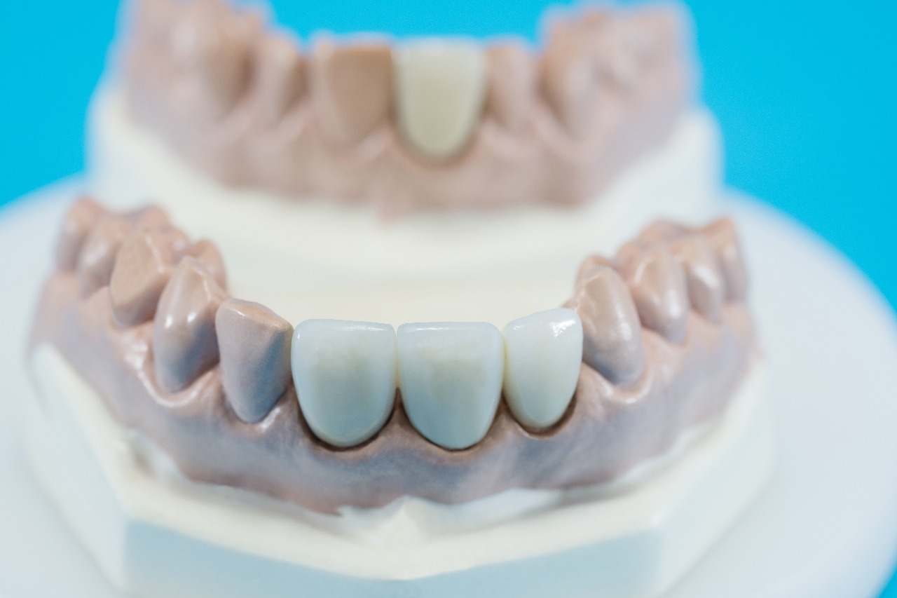 Dental Crowns & Bridges 