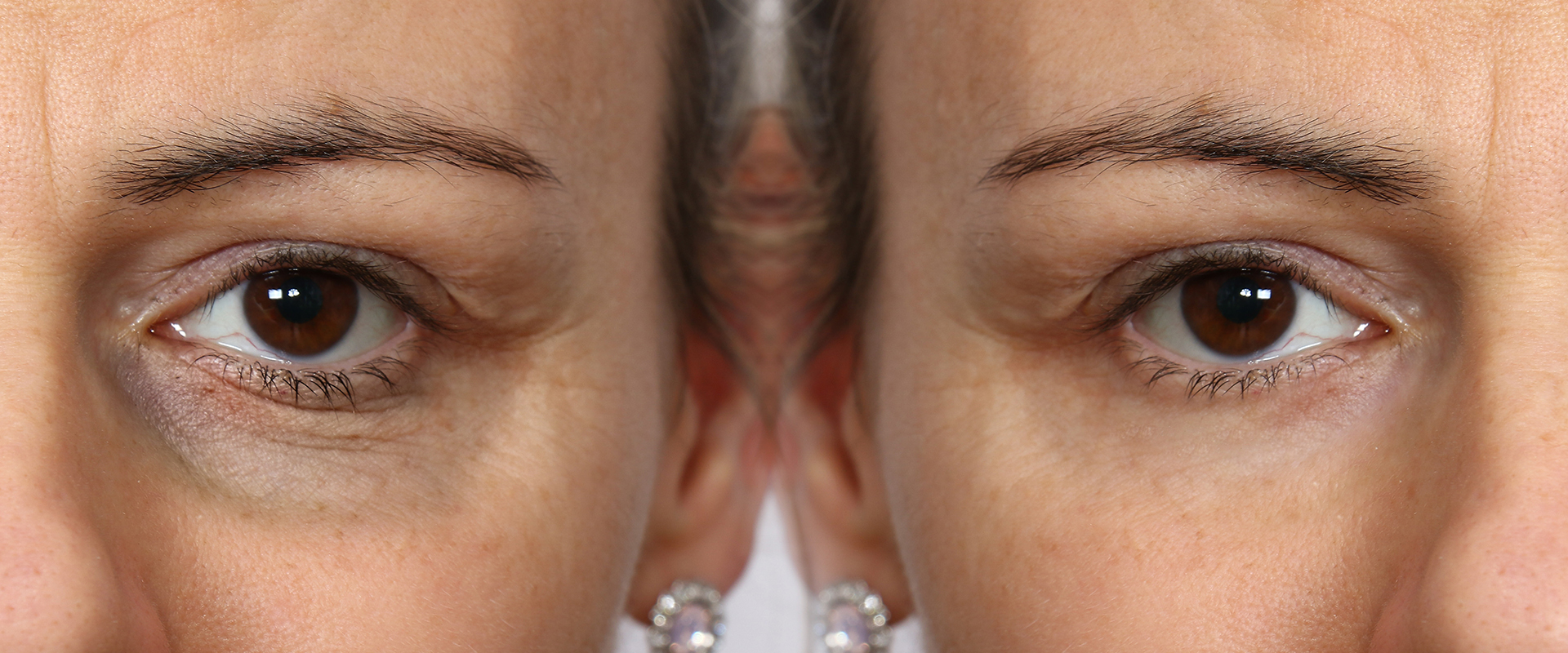 Blepharoplasty 