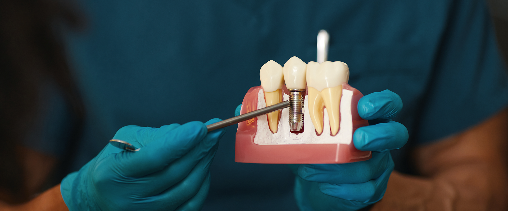 Dental Implants 