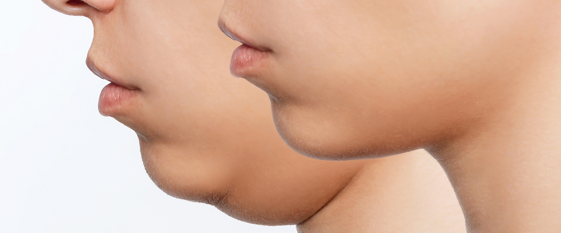 facial Fat Reduction Surgery 