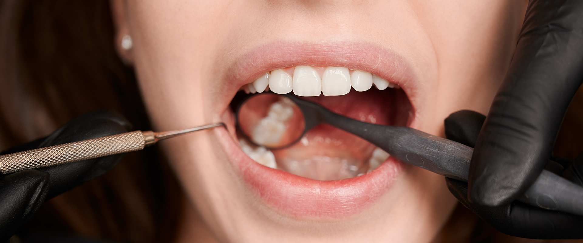 Wisdom Tooth Removal 